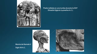 Piedra tallada en una tumba durante la XIXª
Dinastía Egipcia (1400años A.C.)
Momia de RamsésV
Siglo XII A.C.
 