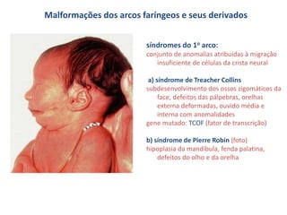 Malformações dos arcos faríngeos e seus derivados
síndromes do 1o arco:
conjunto de anomalias atribuidas à migração
insuficiente de células da crista neural
a) síndrome de Treacher Collins
subdesenvolvimento dos ossos zigomáticos da
face, defeitos das pálpebras, orelhas
externa deformadas, ouvido média e
interna com anomalidades
gene mutado: TCOF (fator de transcrição)
b) síndrome de Pierre Robin (foto)
hipoplasia da mandíbula, fenda palatina,
defeitos do olho e da orelha
 