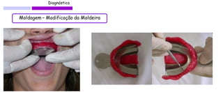 Diagnóstico 
Moldagem – Modificação da Moldeira  