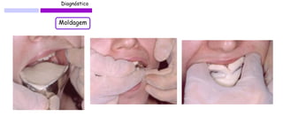 Diagnóstico 
Moldagem  