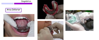 Diagnóstico 
Arco Inferior  