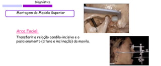Diagnóstico 
Montagem do Modelo Superior 
Arco Facial: 
Transferir a relação condilo-incisivo e o posicionamento (altura e inclinação) da maxila.  