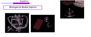 Diagnóstico 
Montagem do Modelo Superior  