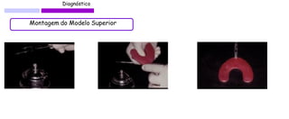 Diagnóstico 
Montagem do Modelo Superior  