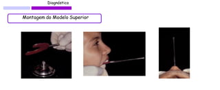 Diagnóstico 
Montagem do Modelo Superior  