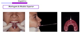 Diagnóstico 
Montagem do Modelo Superior  