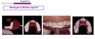 Diagnóstico 
Montagem do Modelo Superior  