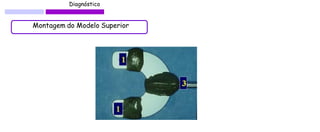 Diagnóstico 
Montagem do Modelo Superior  