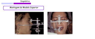 Diagnóstico 
Montagem do Modelo Superior  