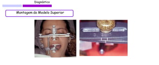 Diagnóstico 
Montagem do Modelo Superior  