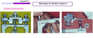 Diagnóstico 
Montagem do Modelo Superior 
Distância Intercondilar 
 