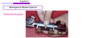 Diagnóstico 
Montagem do Modelo Superior 
Distância Intercondilar  