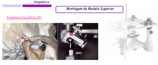 Diagnóstico 
Trajetória Condílica 30° 
Montagem do Modelo Superior  