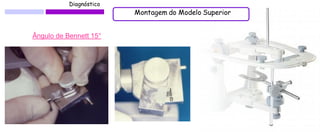 Diagnóstico 
30° 
Ângulo de Bennett 15° 
Montagem do Modelo Superior  