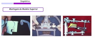 Diagnóstico 
Montagem do Modelo Superior 
 