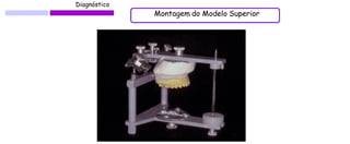 Diagnóstico 
Montagem do Modelo Superior  