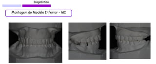 Diagnóstico 
Montagem do Modelo Inferior - MI  