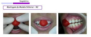 Diagnóstico 
Montagem do Modelo Inferior - RC  