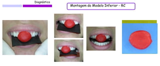 Diagnóstico 
Montagem do Modelo Inferior - RC  
