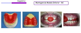 Diagnóstico 
Montagem do Modelo Inferior - RC  