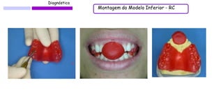 Diagnóstico 
Montagem do Modelo Inferior - RC  