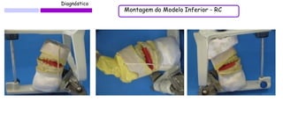 Diagnóstico 
Montagem do Modelo Inferior - RC  