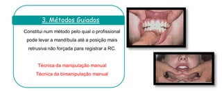 Constitui num método pelo qual o profissional pode levar a mandíbula até a posição mais retrusiva não forçada para registrar a RC. 
Técnica da manipulação manual 
Técnica da bimanipulação manual 
. 
3. Métodos Guiados  