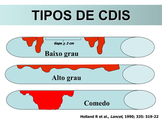 Alto grau
Holland R et al., Lancet, 1990; 335: 519-22
Baixo grau
Gaps > 2 cm
Comedo
TIPOS DE CDIS
 