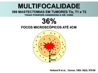 Holland R et al., Cancer, 1985; 56(5): 979-90
36%
FOCOS MICROSCÓPICOS ATÉ 4CM
2cm
2cm
MULTIFOCALIDADE
399 MASTECTOMIAS EM TUMORES Tis, T1 e T2
TODAS POSSÍVEIS CANDIDATAS À CIR. CONS.
 