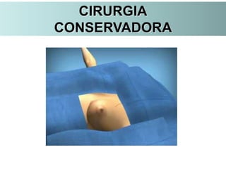 CIRURGIA
CONSERVADORA
 