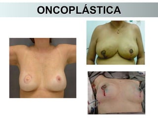 ONCOPLÁSTICA
 