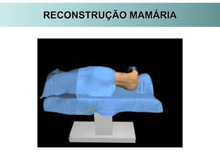 RECONSTRUÇÃO MAMÁRIA
 