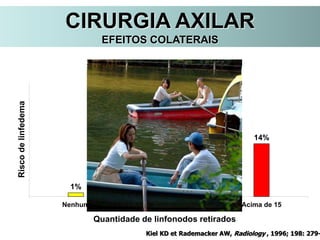 CIRURGIA AXILAR
EFEITOS COLATERAIS
1%
7%
14%
Nenhum 1 a 10 Acima de 15
Riscodelinfedema
Quantidade de linfonodos retirados
Kiel KD et Rademacker AW, Radiology , 1996; 198: 279-
 