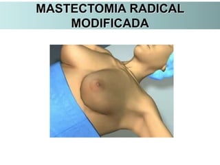 MASTECTOMIA RADICAL
MODIFICADA
 