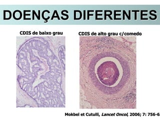 CDIS de baixo grau CDIS de alto grau c/comedo
Mokbel et Cutulli, Lancet Oncol, 2006; 7: 756-65
DOENÇAS DIFERENTES
 