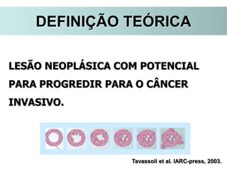 Tavassoli et al. IARC-press, 2003.
LESÃO NEOPLÁSICA COM POTENCIAL
PARA PROGREDIR PARA O CÂNCER
INVASIVO.
DEFINIÇÃO TEÓRICA
 