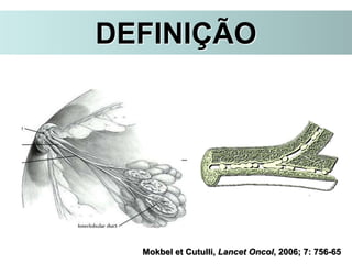 Mokbel et Cutulli, Lancet Oncol, 2006; 7: 756-65
DEFINIÇÃO
 