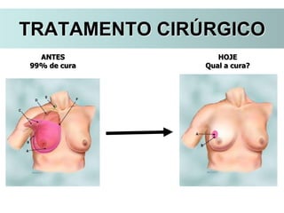 ANTES
99% de cura
HOJE
Qual a cura?
TRATAMENTO CIRÚRGICO
 