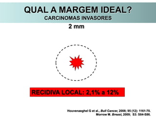 Houvenaeghel G et al., Bull Cancer, 2008; 95 (12): 1161-70.
Morrow M. Breast, 2009; S3: S84-S86.
2 mm
RECIDIVA LOCAL: 2,1% a 12%
QUAL A MARGEM IDEAL?
CARCINOMAS INVASORES
 