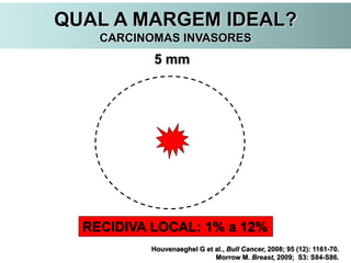 Houvenaeghel G et al., Bull Cancer, 2008; 95 (12): 1161-70.
Morrow M. Breast, 2009; S3: S84-S86.
5 mm
RECIDIVA LOCAL: 1% a 12%
QUAL A MARGEM IDEAL?
CARCINOMAS INVASORES
 