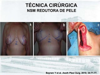 TÉCNICA CIRÚRGICA
NSM REDUTORA DE PELE
Bayram Y et al. Aesth Plast Surg, 2010; 34:71-77.
 