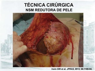 TÉCNICA CIRÚRGICA
NSM REDUTORA DE PELE
Irwin GW et al. JPRAS, 2013; 66:1188-94.
 