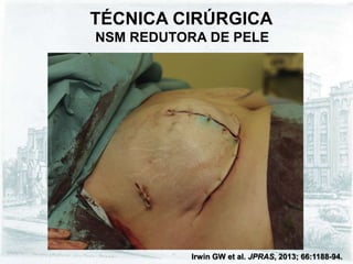TÉCNICA CIRÚRGICA
NSM REDUTORA DE PELE
Irwin GW et al. JPRAS, 2013; 66:1188-94.
 