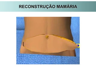 RECONSTRUÇÃO MAMÁRIA
 