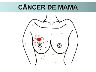 CÂNCER DE MAMA
 