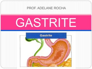 PROF. ADELANE ROCHA
GASTRITE
 