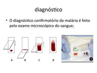 diagióstco
• O diagióstco coifrmatório da malária é feito
pelo exame microscópico do saigue;
 