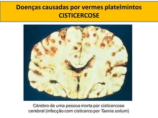 Cérebro de uma pessoa morta por cisticercose
cerebral (infecção com cisticerco por Taenia solium)
Doenças causadas por vermes platelmintos
CISTICERCOSE
 