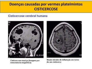 Doenças causadas por vermes platelmintos
CISTICERCOSE
 