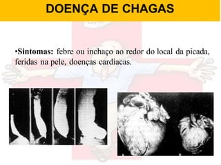 •Sintomas: febre ou inchaço ao redor do local da picada,
feridas na pele, doenças cardíacas.
DOENÇA DE CHAGAS
 